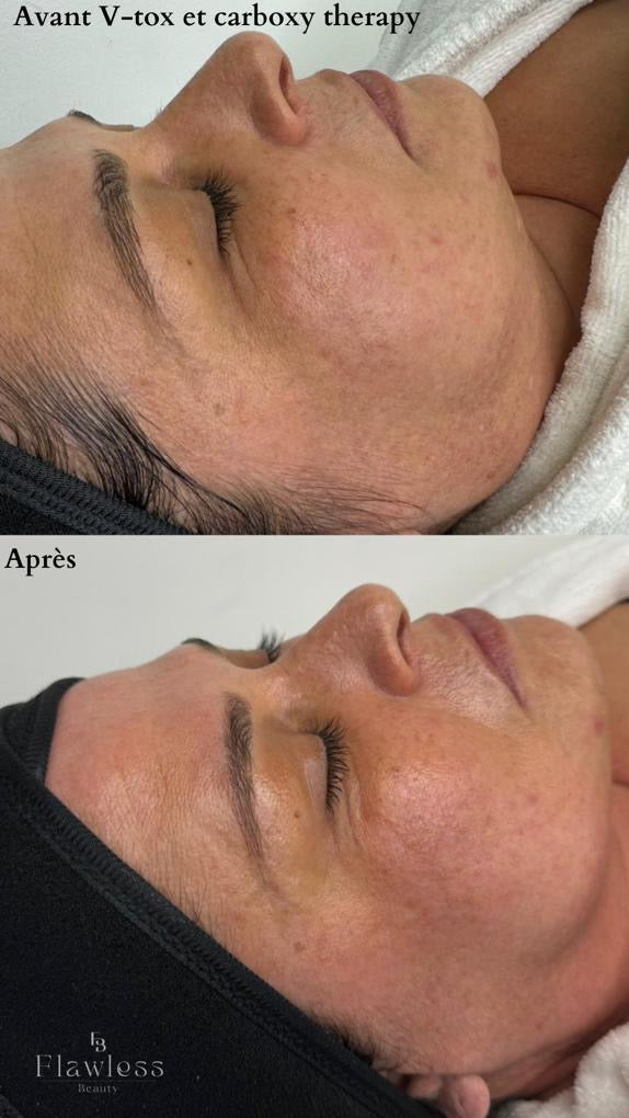 Formation Detatouage & Carbon peel